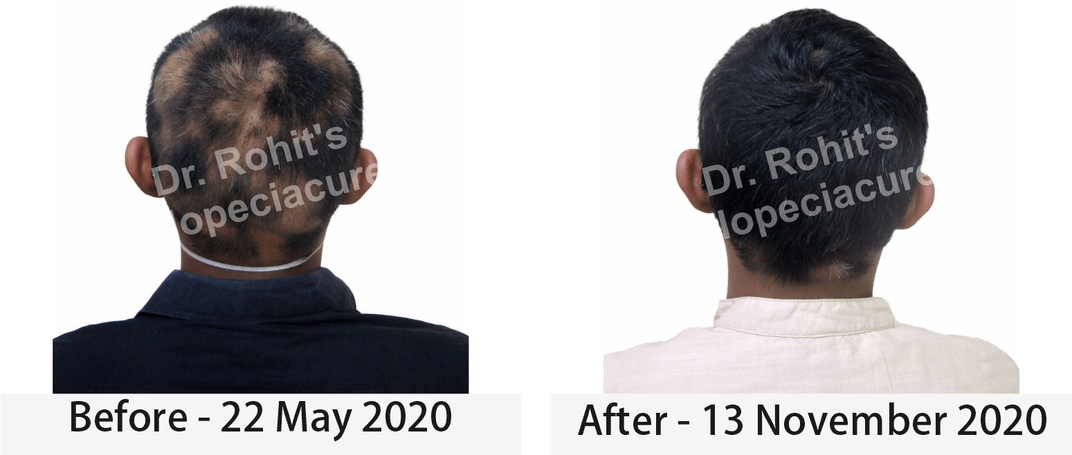 hair loss treatment